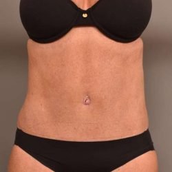 Tummy Tuck Before & After Patient #273