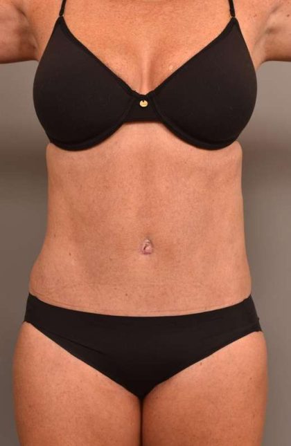 Tummy Tuck Before & After Patient #273
