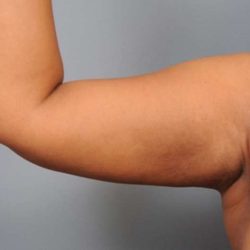 Arm Liposuction Before & After Patient #833