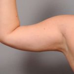 Arm Liposuction Before & After Patient #842