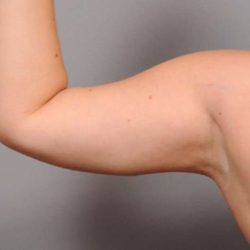 Arm Liposuction Before & After Patient #842