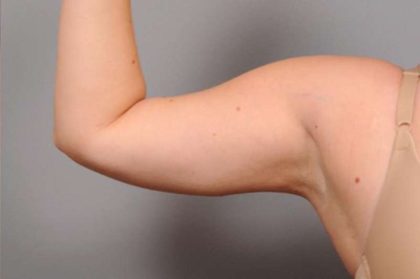 Arm Liposuction Before & After Patient #842