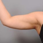 Arm Liposuction Before & After Patient #851