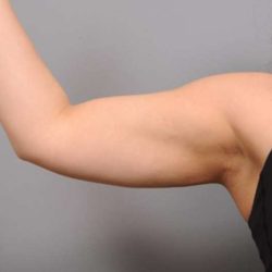 Arm Liposuction Before & After Patient #851