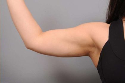 Arm Liposuction Before & After Patient #851