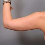 Arm Liposuction Before & After Patient #858