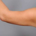 Arm Liposuction Before & After Patient #863