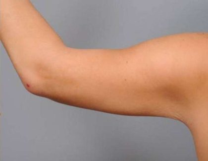 Arm Liposuction Before & After Patient #863