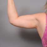 Arm Liposuction Before & After Patient #872