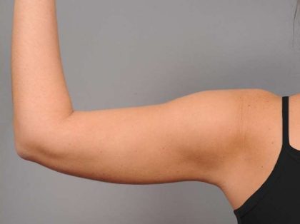 Arm Liposuction Before & After Patient #879