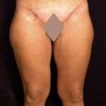 Thigh Lift Before & After Patient #882