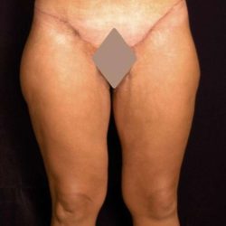Thigh Lift Before & After Patient #882