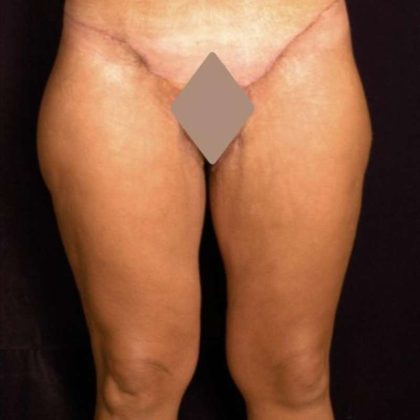 Thigh Lift Before & After Patient #882