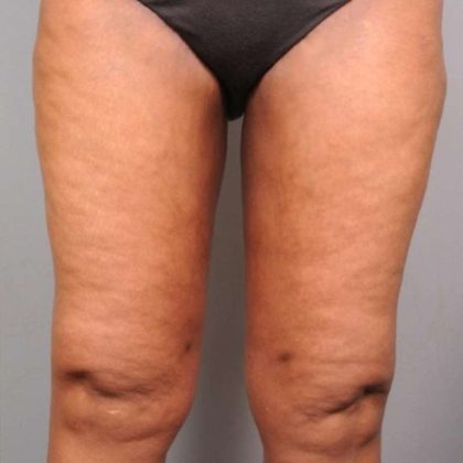 Thigh Lift Before & After Patient #885