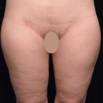 Thigh Lift Before & After Patient #888