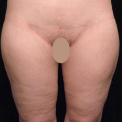 Thigh Lift Before & After Patient #888