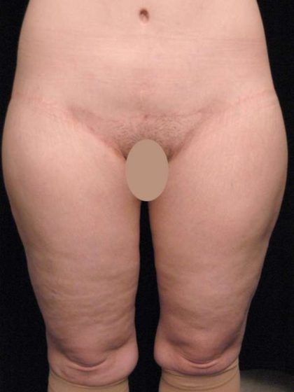 Thigh Lift Before & After Patient #888
