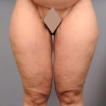 Thigh Lift Before & After Patient #891