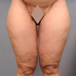 Thigh Lift Before & After Patient #891