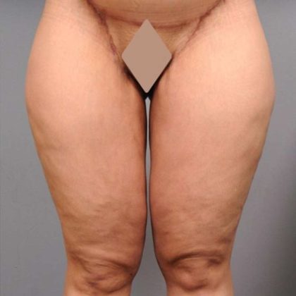Thigh Lift Before & After Patient #891