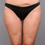 Thigh Lift Before & After Patient #896