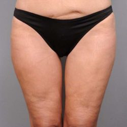 Thigh Lift Before & After Patient #896