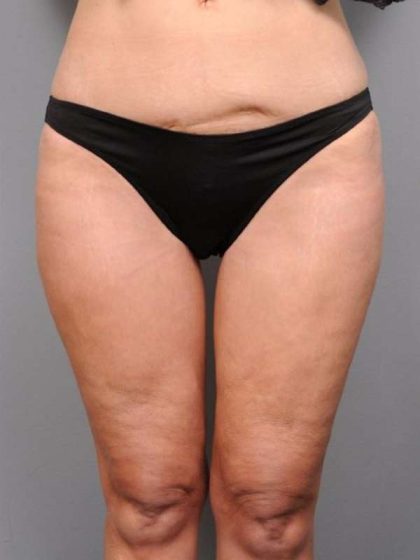 Thigh Lift Before & After Patient #896