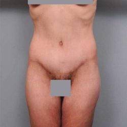 Lower Body Lift Before & After Patient #925
