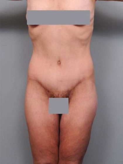 Lower Body Lift Before & After Patient #925
