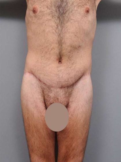 Lower Body Lift Before & After Patient #932