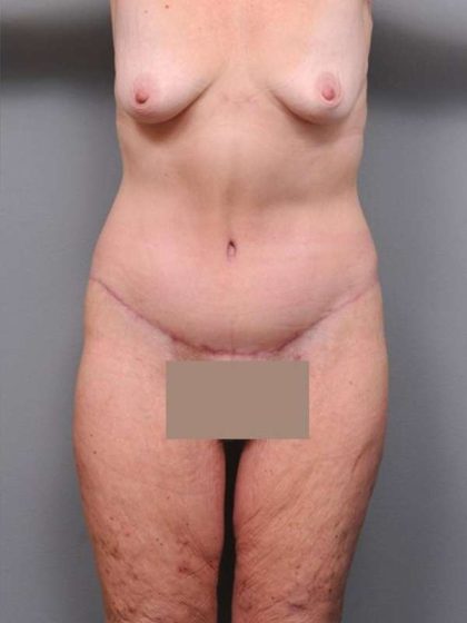 Lower Body Lift Before & After Patient #965