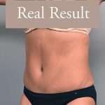 Tummy Tuck Before & After Patient #303