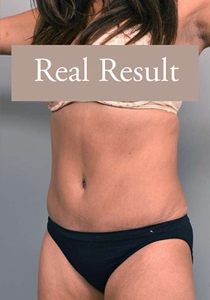 Tummy Tuck Before & After Patient #303