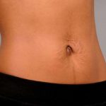 Belly Button Surgery Before & After Patient #1079