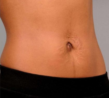 Belly Button Surgery Before & After Patient #1079
