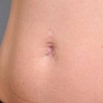 Belly Button Surgery Before & After Patient #1084