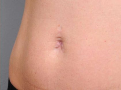 Belly Button Surgery Before & After Patient #1084