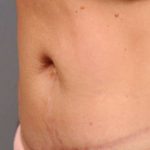 Belly Button Surgery Before & After Patient #1089