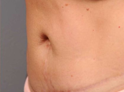 Belly Button Surgery Before & After Patient #1089