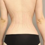 Scarless Rib Contouring (RibXcar) Before & After Patient #1097