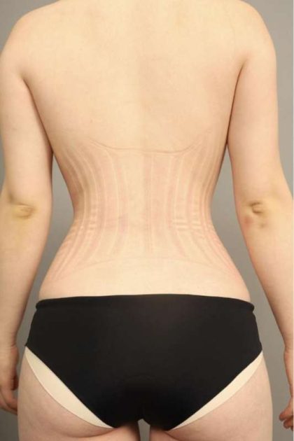 Scarless Rib Contouring (RibXcar) Before & After Patient #1097