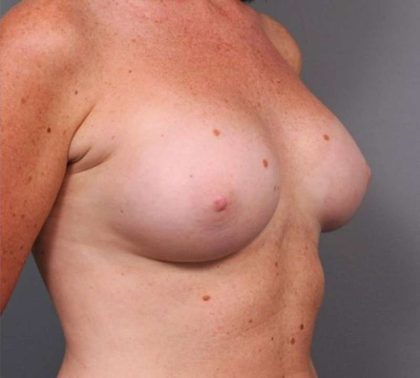 Under The Muscle Breast Augmentation Before & After Patient #1128