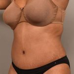Tummy Tuck Before & After Patient #312