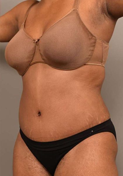 Tummy Tuck Before & After Patient #312