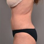 Tummy Tuck Before & After Patient #319