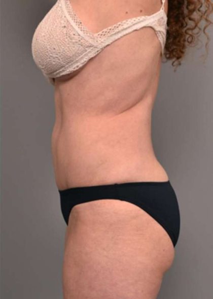 Tummy Tuck Before & After Patient #319