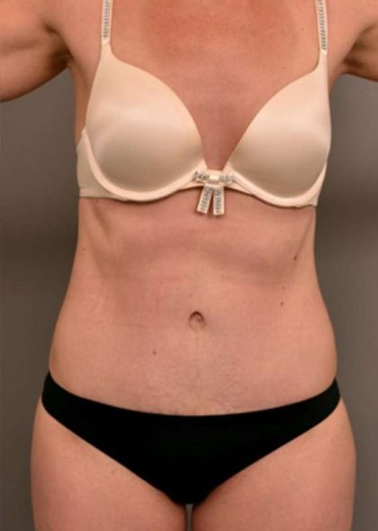 Tummy Tuck Before & After Patient #329