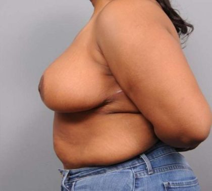 Breast Reduction Before & After Patient #1293