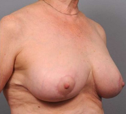 Breast Reduction Before & After Patient #1298
