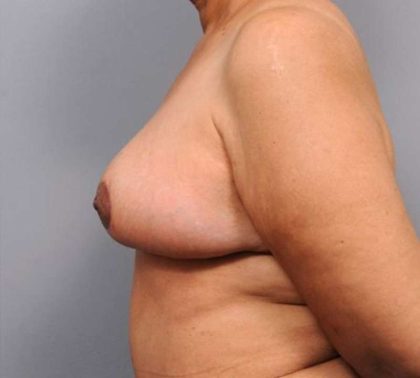 Breast Reduction Before & After Patient #1303